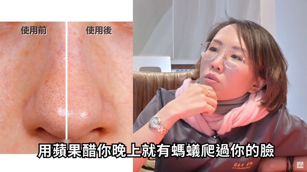 医生看法： 对于即沖咖啡粉和生鸡蛋的做法，庄医生认为其实与使用黑头贴都是同一个概念，她觉得大家与其继续盲目苦寻去黑头粉刺方法，倒不如在日常生活做好去角质程序和多擦A酸 (*注意：须按个人肤况及医生建议) 。至于最后的收敛做法，她认为简直是无稽之谈，这个做法不仅没有实际功效，更有机会为脸部引来蚂蚁，建议大家还是不要使用。