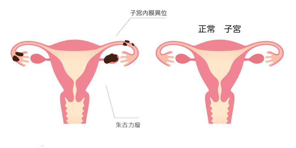 Q1. 朱古力瘤是什么？ 朱古力瘤，医学上称为子宫内膜异位。子宫内膜，顾名思义，是存在于子宫内的。子宫内膜会随着月经周期的荷尔蒙变化而逐渐增厚并充血，为受孕做好準备。如果当月并未受孕，子宫内膜就会脱落，形成月经。但当部份本应存在于子宫内的内膜组织在子宫外的其他地方生长，这就是子宫内膜异位。与正常的子宫内膜一样，这些异位的子宫内膜，同样会随着每次月经週期增厚并充血，而当血液流到体腔内，就会使患者发炎并感到疼痛。子宫内膜异位可以发生在输卵管、子宫颈、阴道、甚至肠道或膀胱，但最常见于卵巢。由于卵巢内的子宫内膜异位常常会形成囊肿，囊肿内有棕色液体，因此被称为「朱古力瘤」。子宫内膜异位的成因目前尚未明确，而主流观点则认为，其发生与月经经血从输卵管倒流至子宫有关。